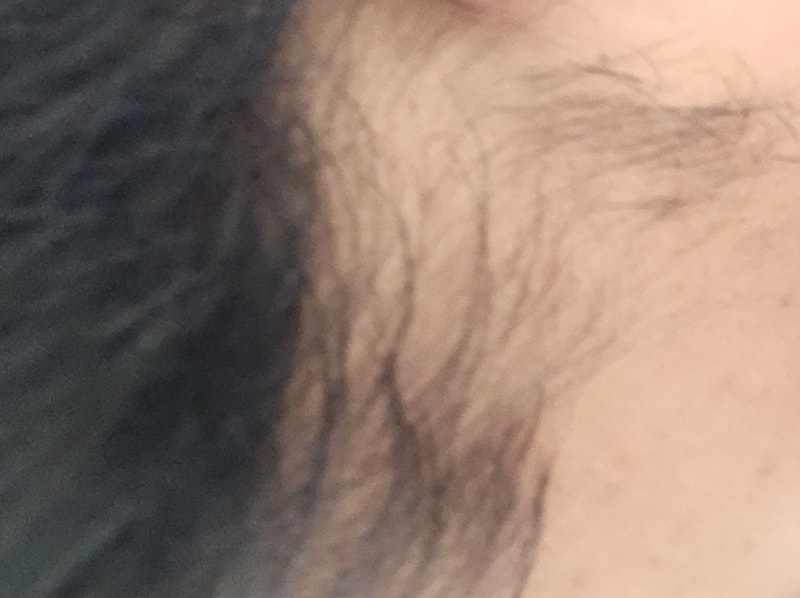 오른쪽구랫나루에 탈모가심해요..