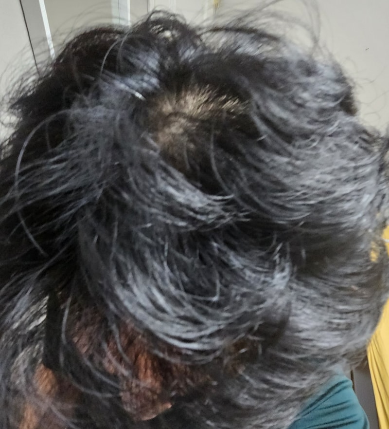 30대 후반 남자 정수리