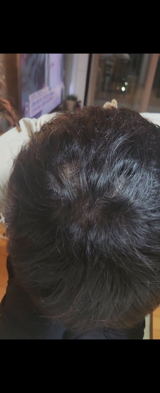 alopecia-20231224-134559-001-resize.jpg