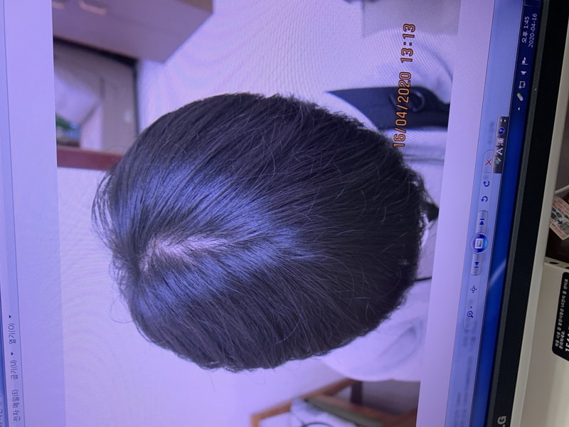 탈모빔.jpg