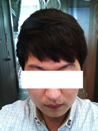 탈모모발이식을 받고 지금의 나의 풍성한 머리숱