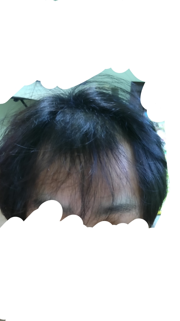 탈모3.jpg