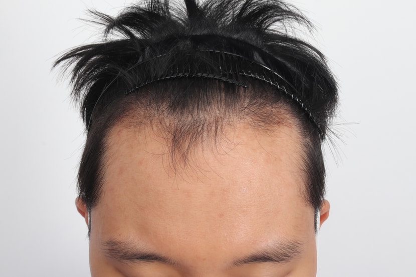 치료 전