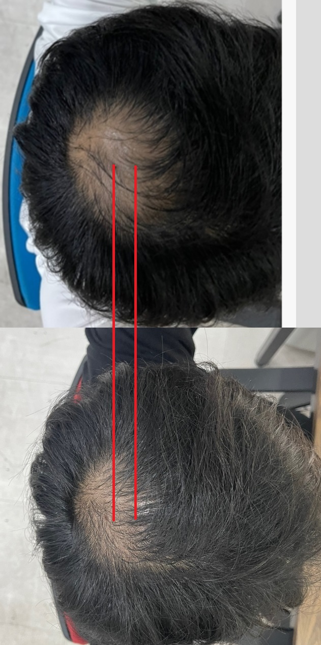 탈모사진 10-02 11-03 비교컷.jpg