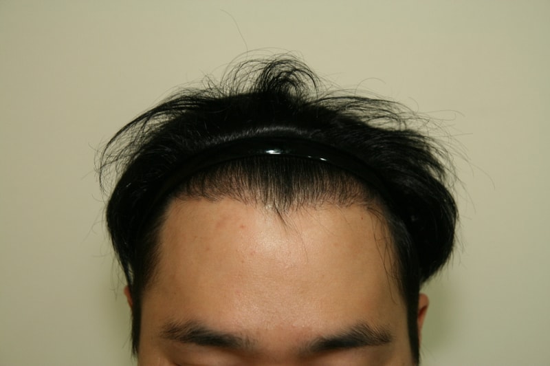 크기변환_수술일년뒤1.JPG