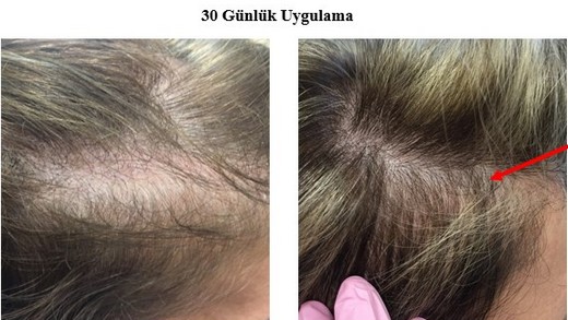 kellik-tedavisi.jpg