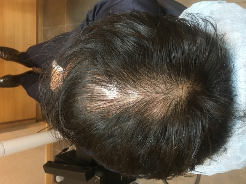 치료전
