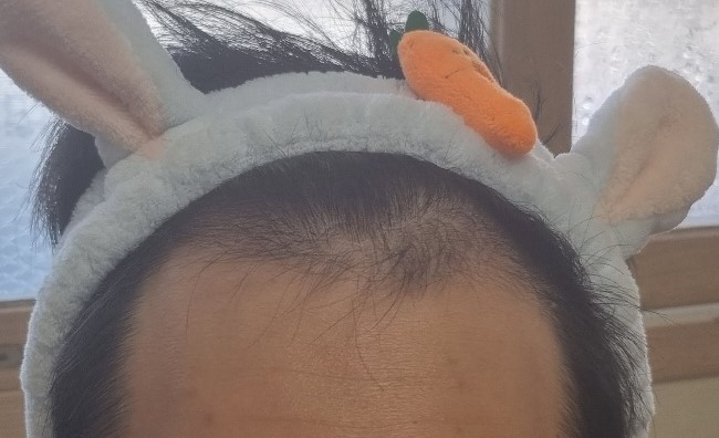 탈모 1.jpg