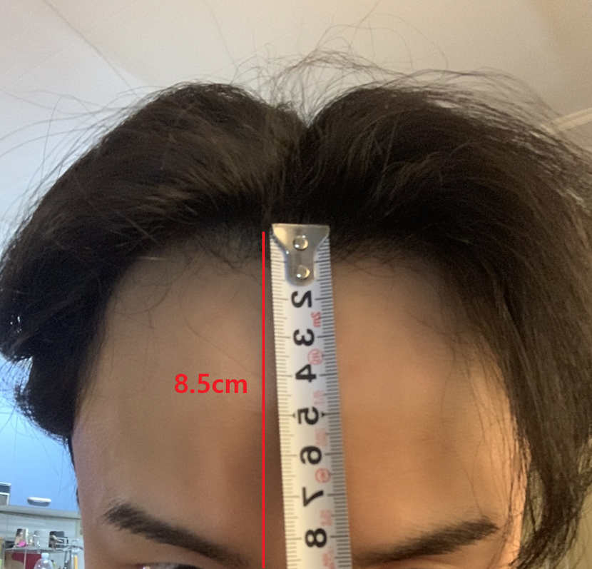 이식 전 이마 8.5-9cm 