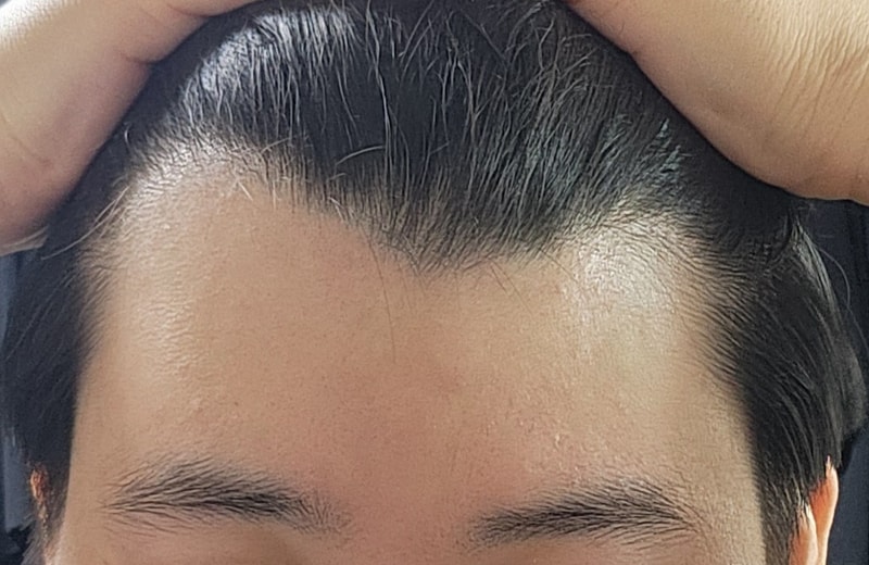 미녹시딜 경구약 부작용과 효과 어떤가요??? 괜찮나요?
