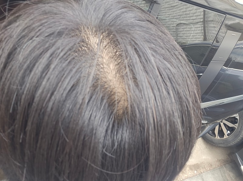 탈모이겠죠..?
