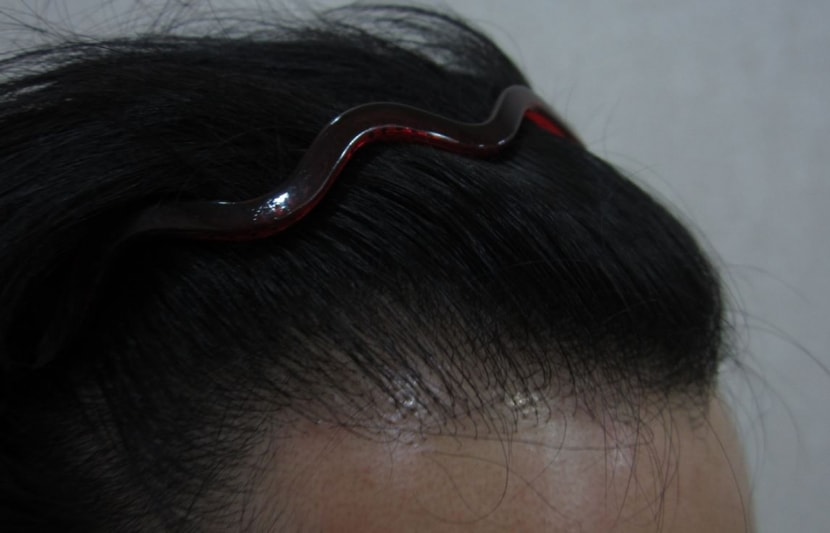 수술 전(R)