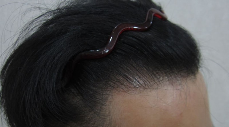 수술전 R(접).JPG