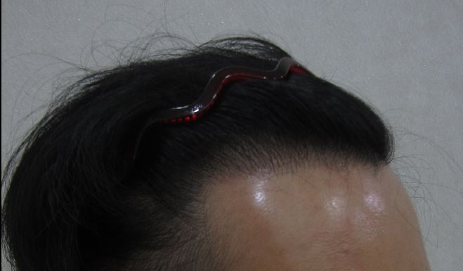 수술 전(R)