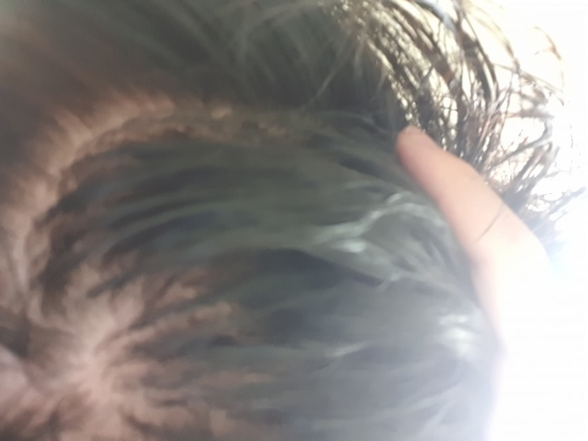 탈모..