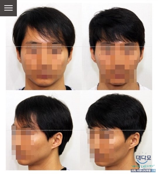 모발이식 효과.jpg