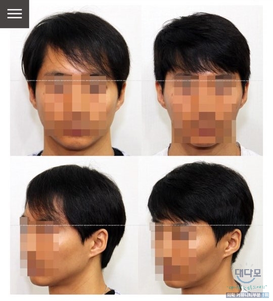 모발이식 효과.jpg