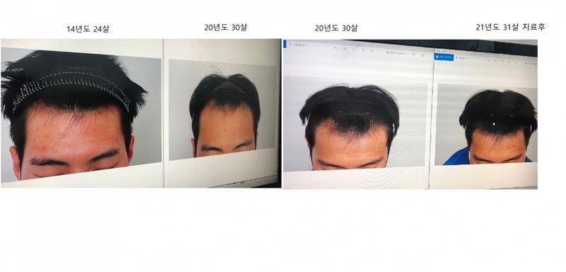 치료후.png