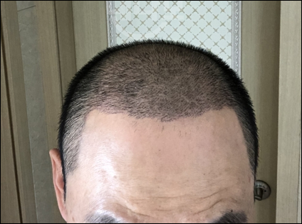 이식 삼주 후 사진.jpeg