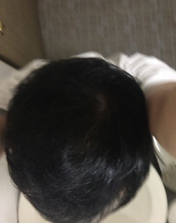 크기변환_사본 -최근 정수리.png