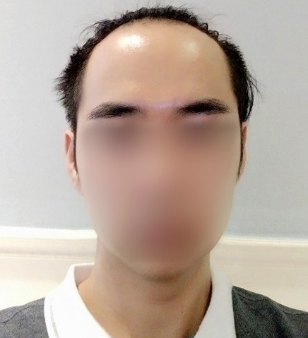 신동찬비포.PNG