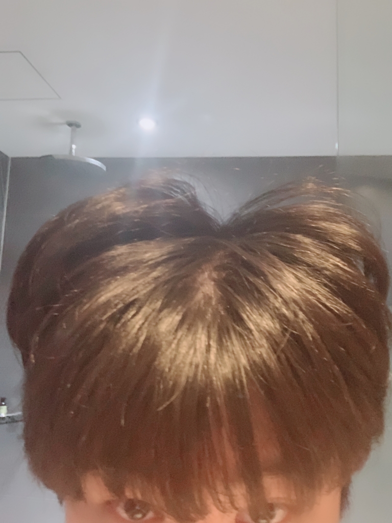 두피가보이기시작 연모화