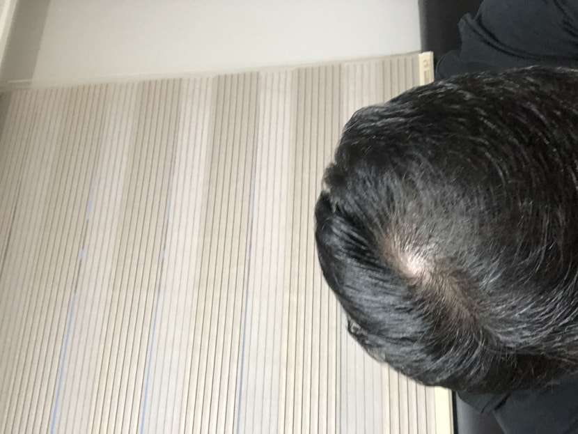 정수리