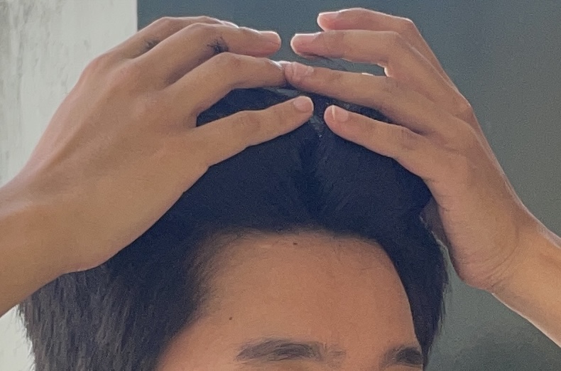 m자 탈모일까요
