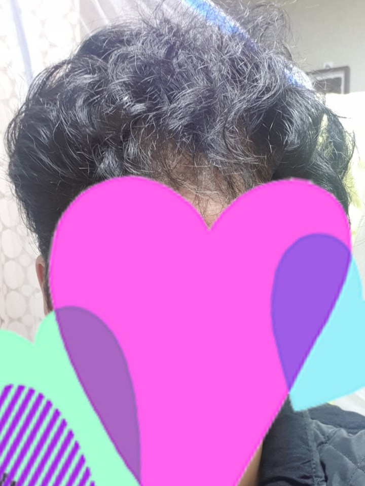 탈모2.jpg