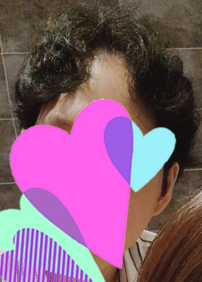 탈모 1.jpg