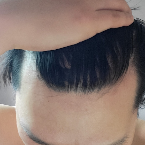 캡처 정면 이마.png