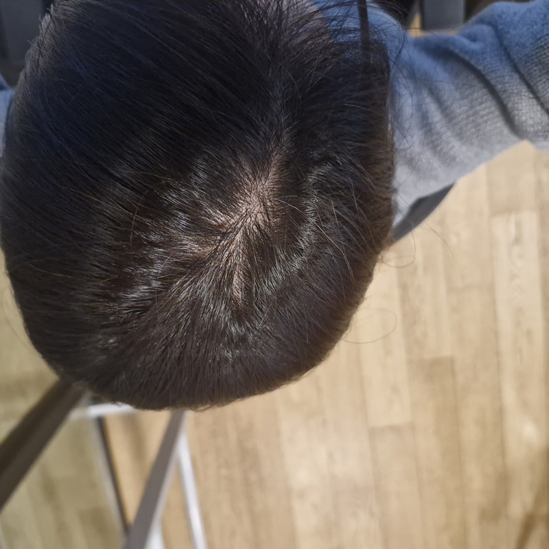 탈모 시작 일까요?