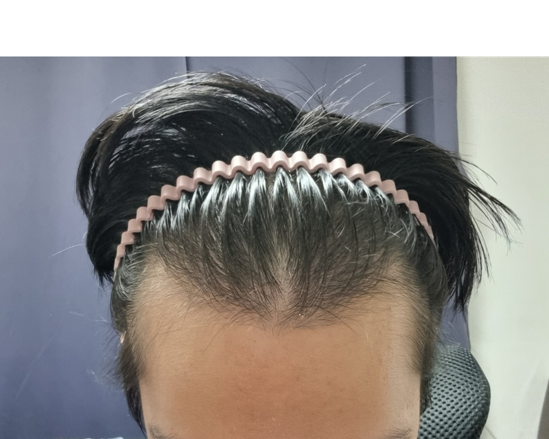 탈모 사진.png