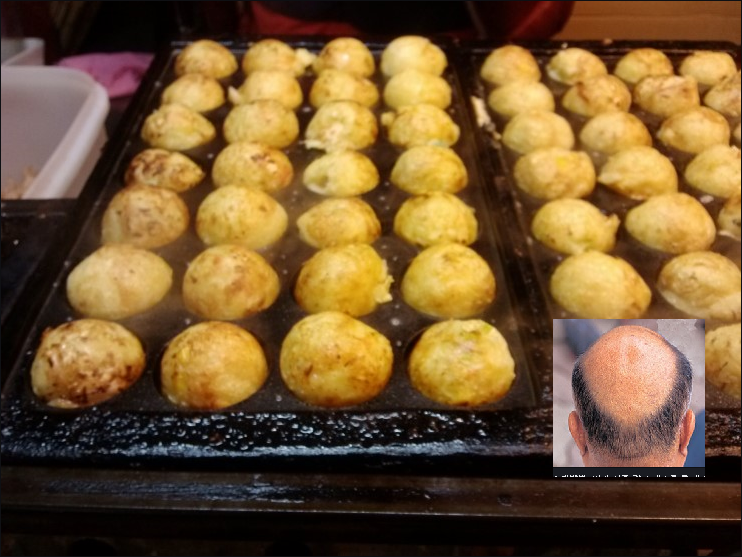 탈모야끼.png