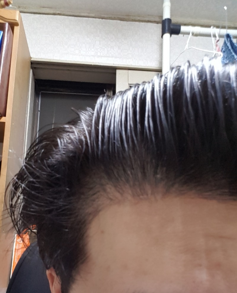 9개월 왼쪽이마.jpg