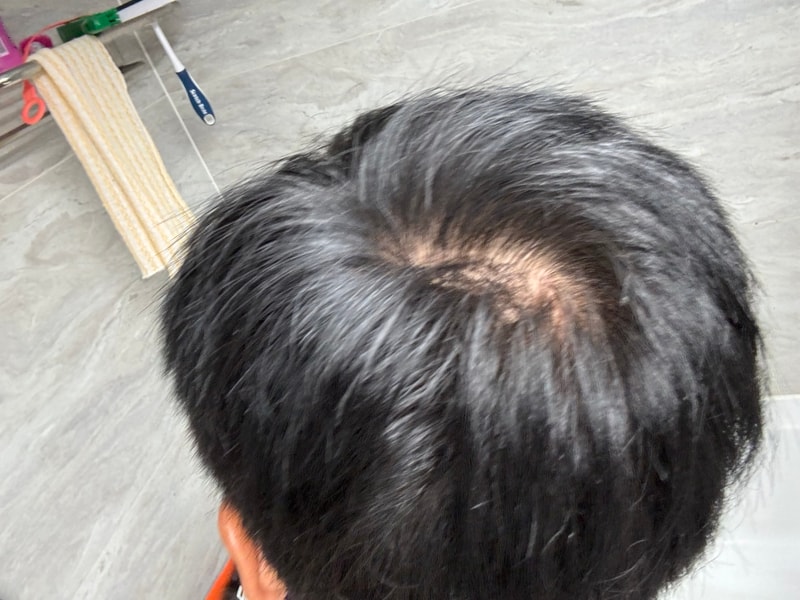 정수리 탈모 같나요?