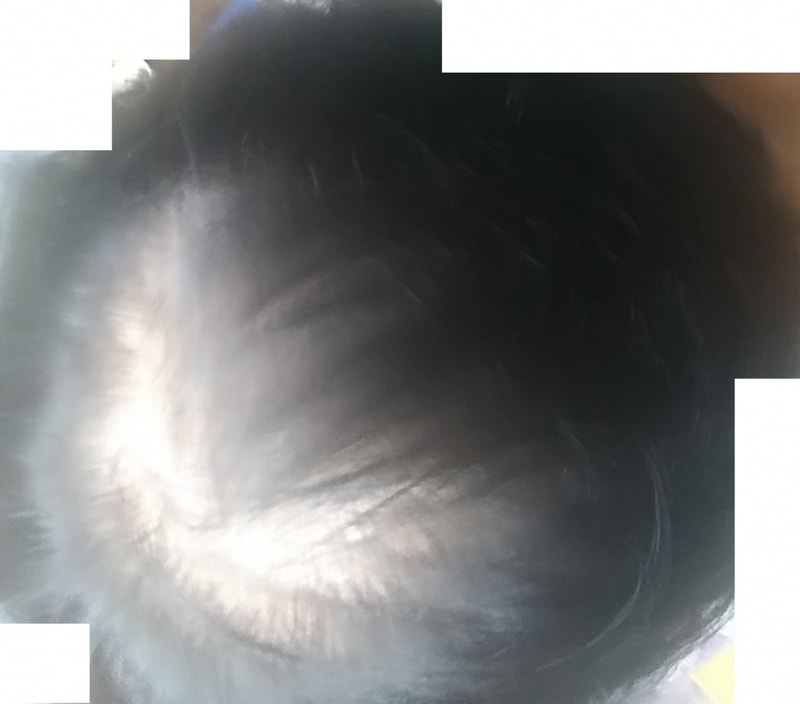탈모 2.jpg