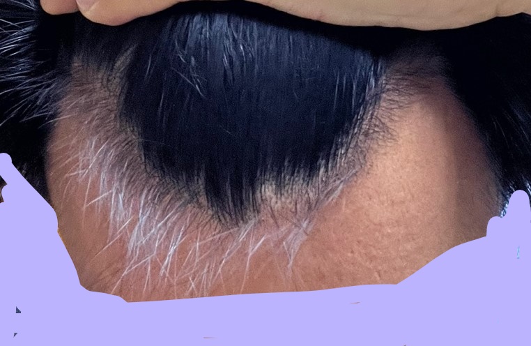 3달 이마 2_LI.jpg