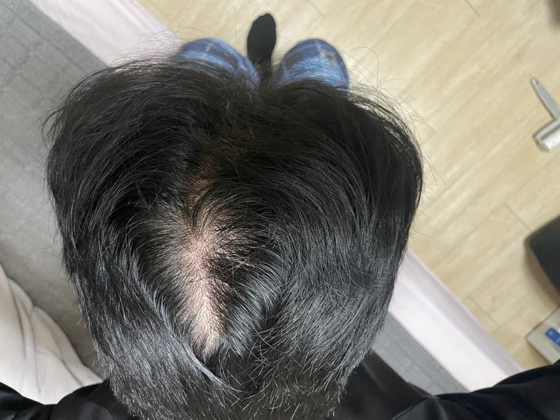 뒷통수 탈모 ㅠㅠ