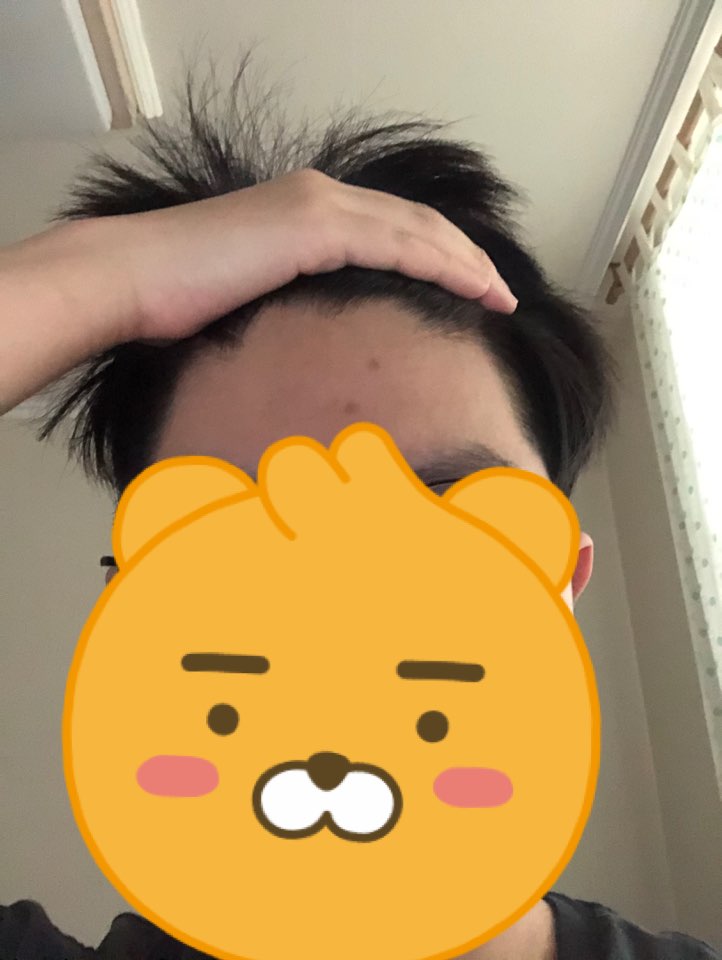 탈모.jpg
