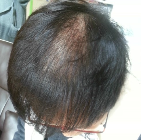 이식수술1개월차.jpg