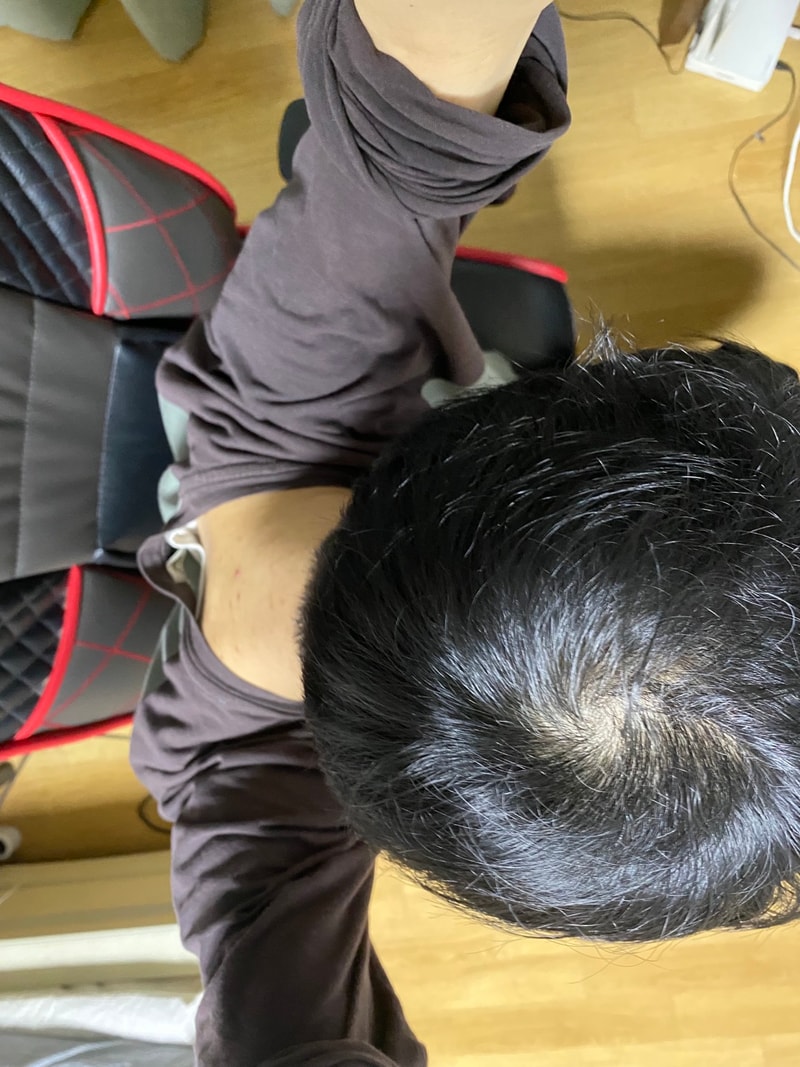 3.9일탈모3.jpg