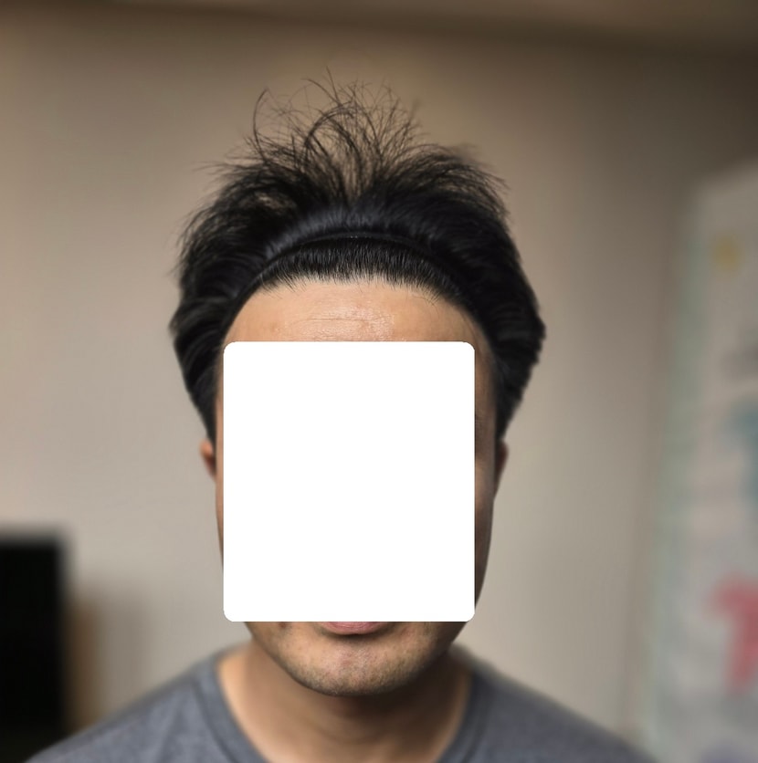 수술 전