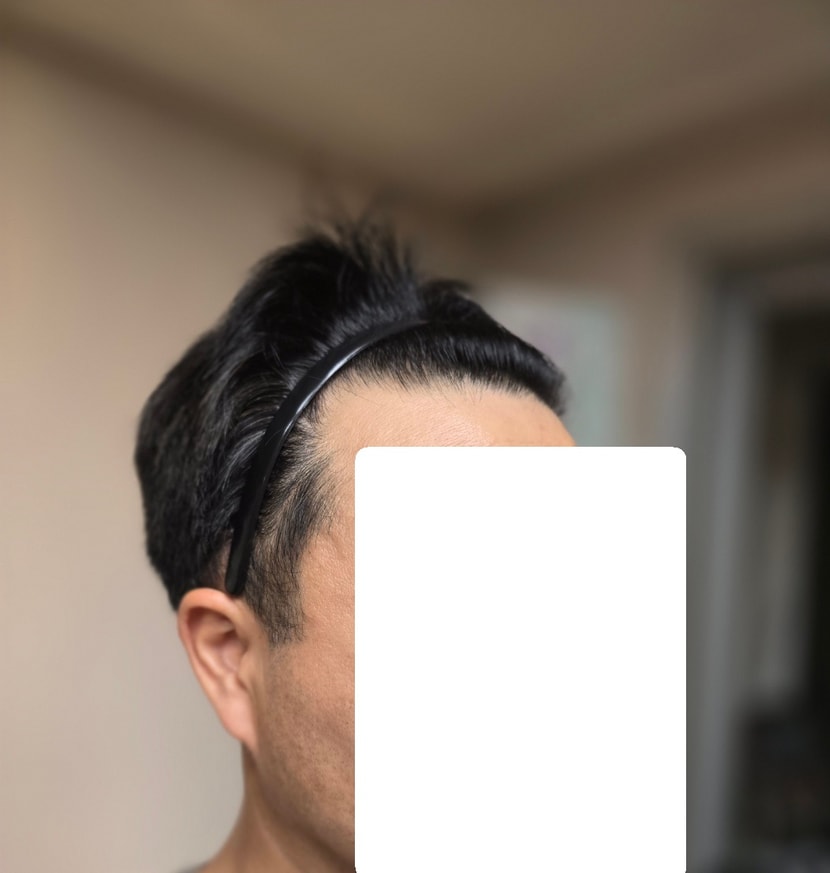 수술 전