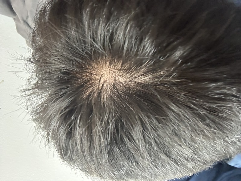 예전부터 정수리 탈모라고 생각 했는데 심하나요?