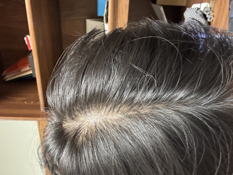 25세 남성 탈모 고민입니다 평가해주세요