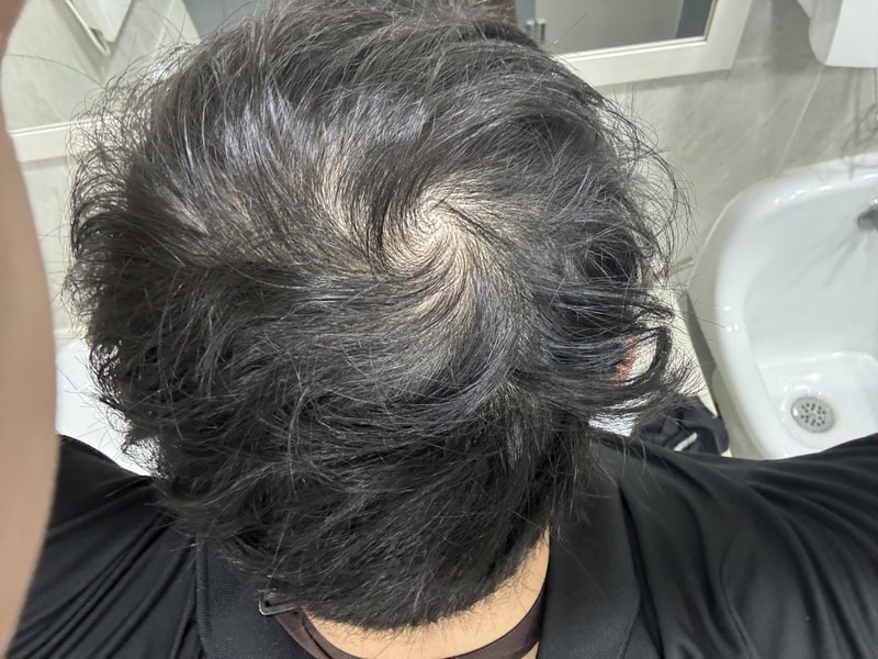 23살 탈모온거 같습니다