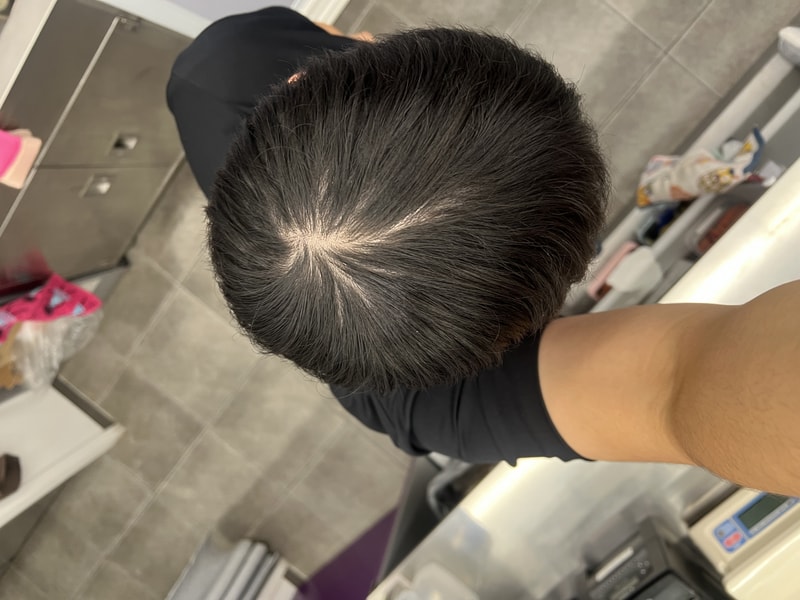 저 탈모인가요? 22살이네...