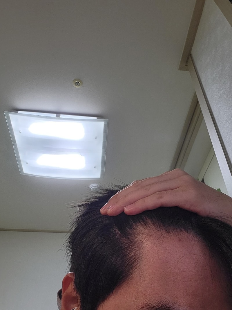 탈모3.jpg
