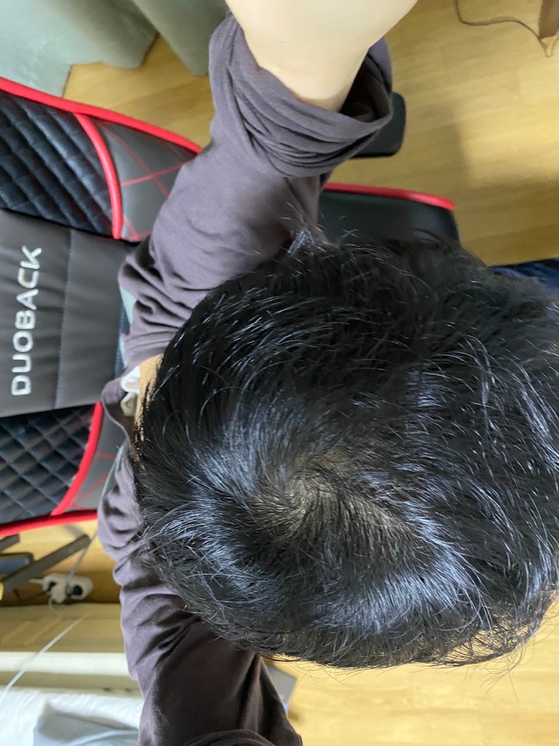 3.9일 탈모1.jpg